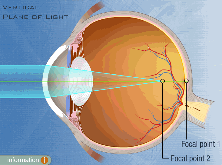 deplasarea focalizării laserului oftalmic)