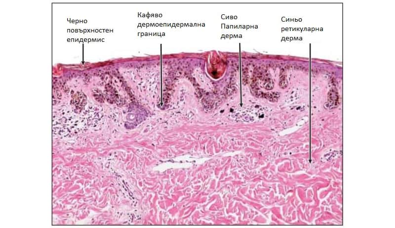 Дерматоскопията – съвременен метод в оценката на риска при пигментните меланоцитни невуси