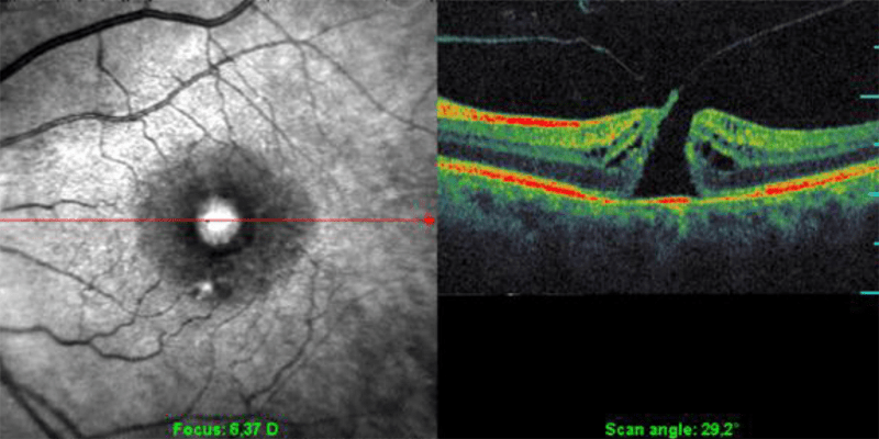 Оптична кохерентна томография за диагностика и проследяване на социалнозначими очни заболявания
