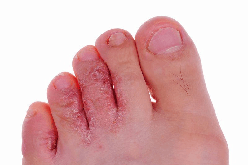 Гъбични инфекции на кожата – кога да мислим за тях?