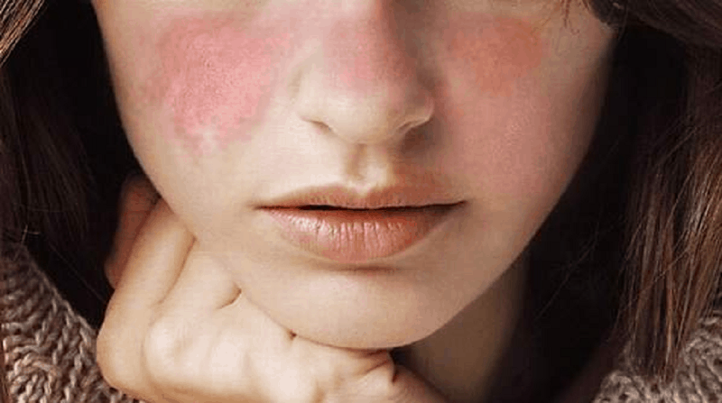 Кожни прояви при lupus erythematosus