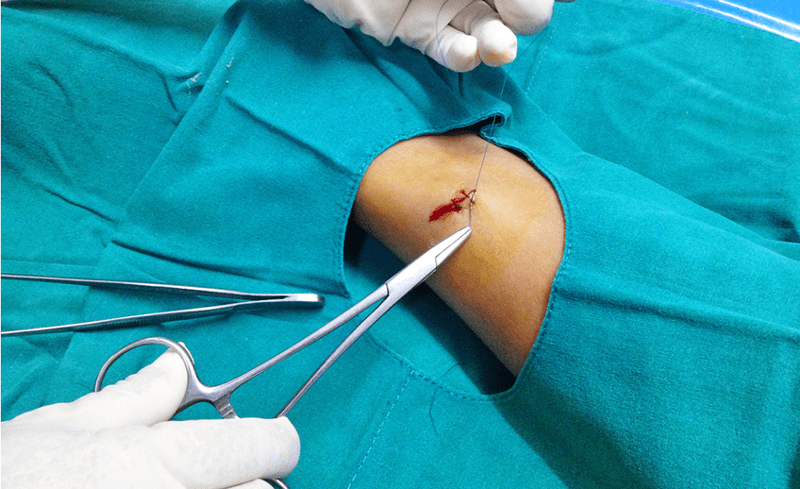 Оперативно лечение на кожните тумори