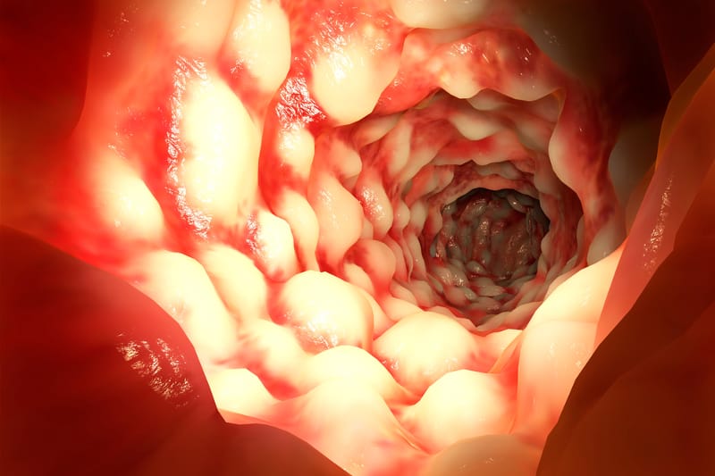 Morbus Crohn