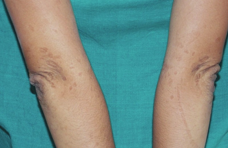 Синдром на Киндлер