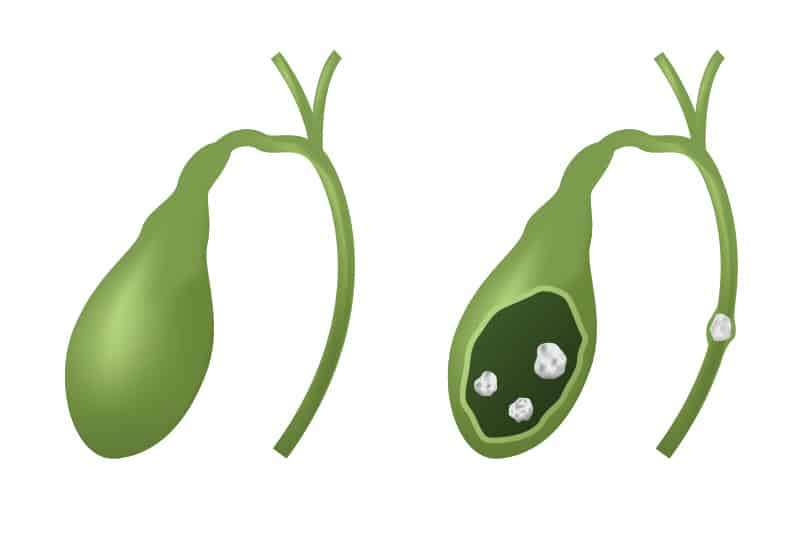 Холедохолитиаза – съвременен терапевтичен подход