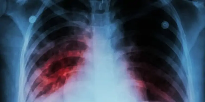 Туберкулоза. Методични указания за лечение