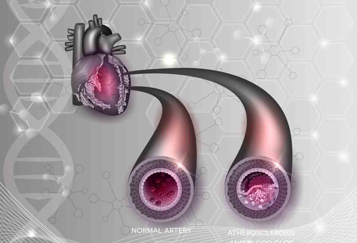 Повишен тропонин