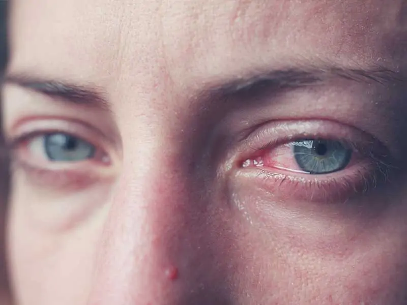 Синдром на червеното око