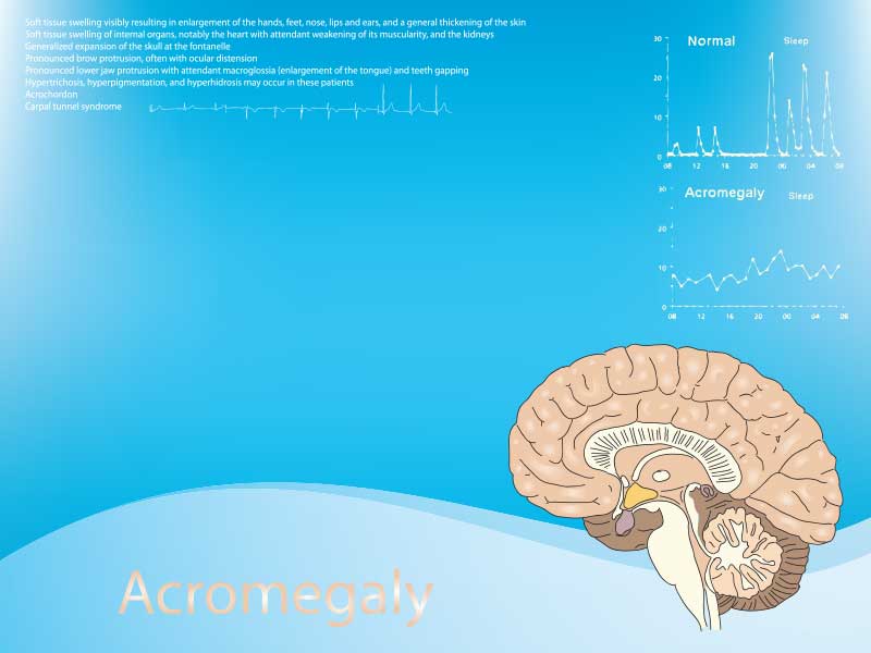 Акромегалия и гигантизъм