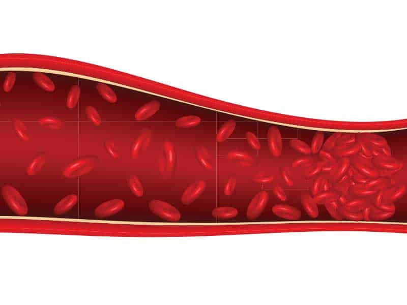 Кaрцином-асоциирана тромбоза - проблем