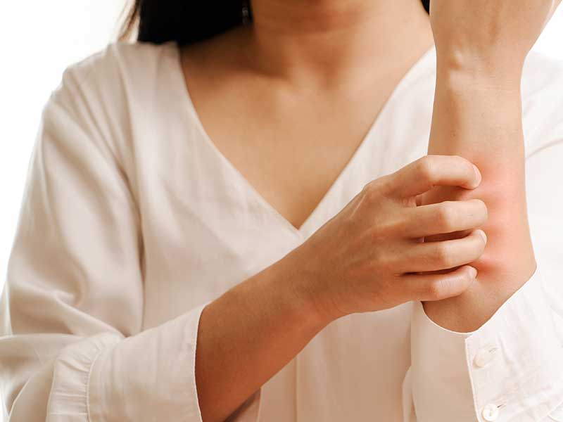 алергичен контактен дерматит