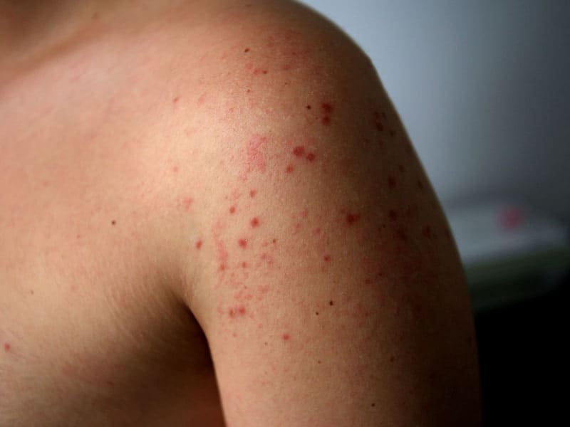 проблеми с морбили