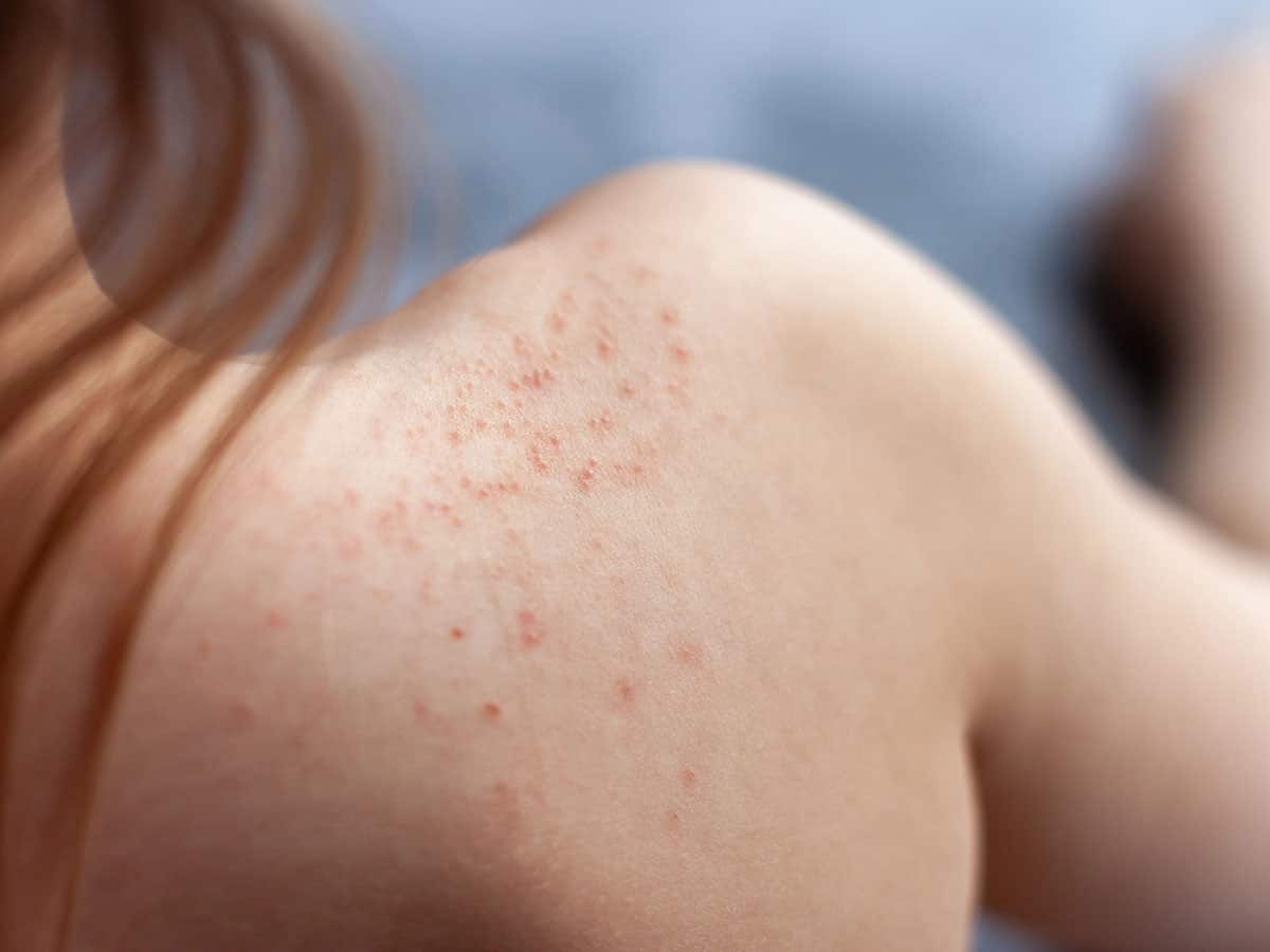 пигментни кожни лезии