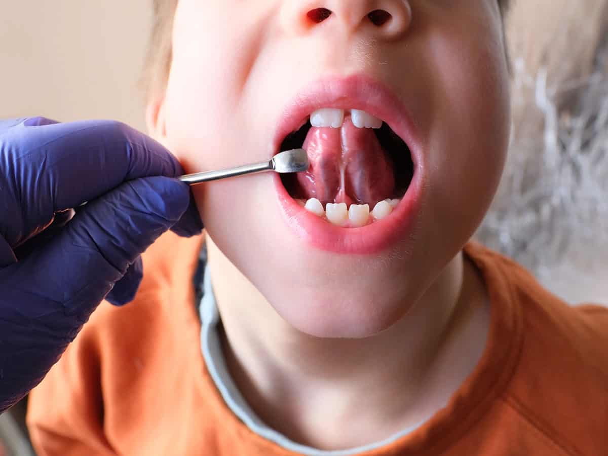 Ankiloglossia - къс езичен френулум