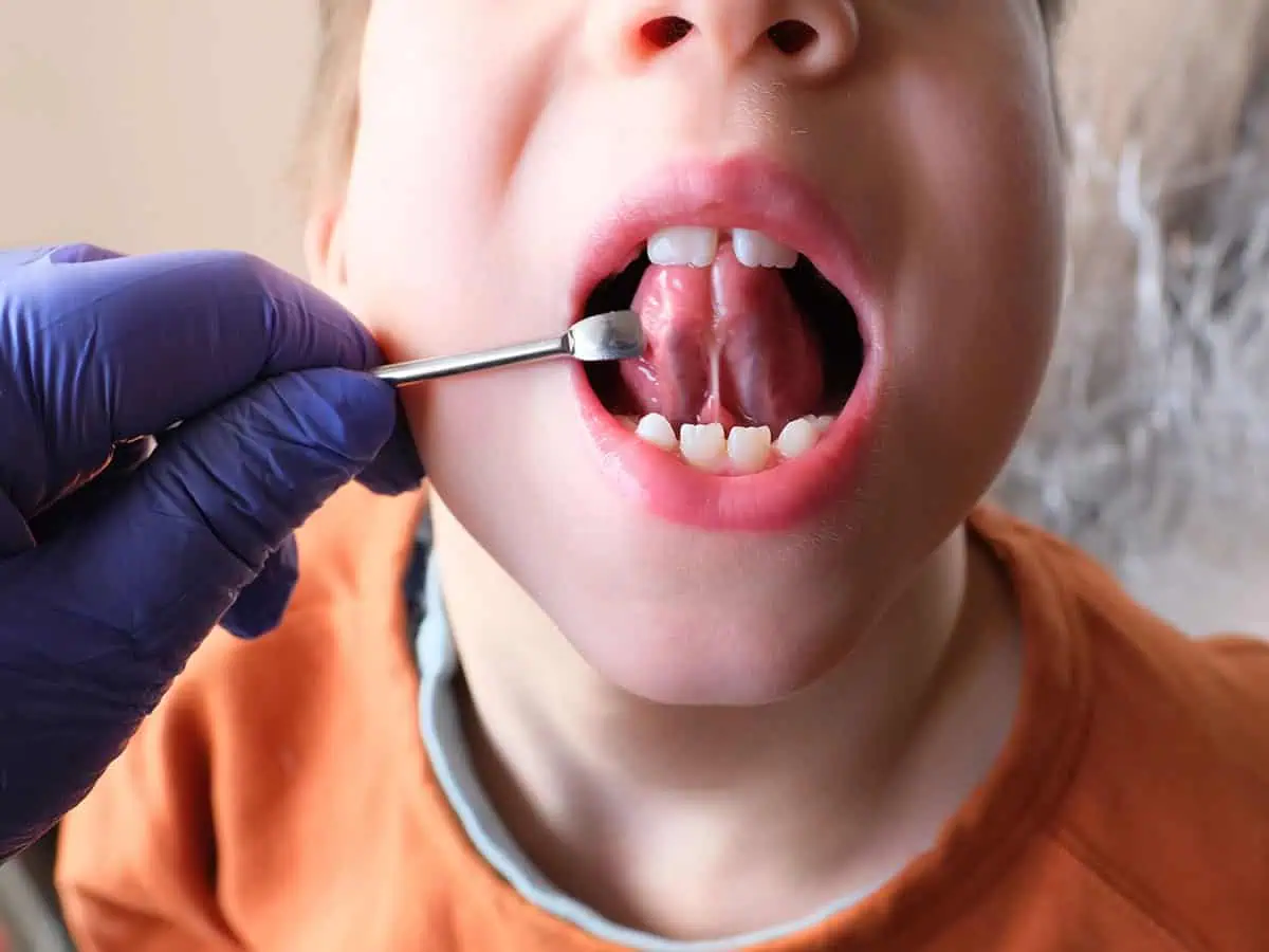 Ankiloglossia - къс езичен френулум