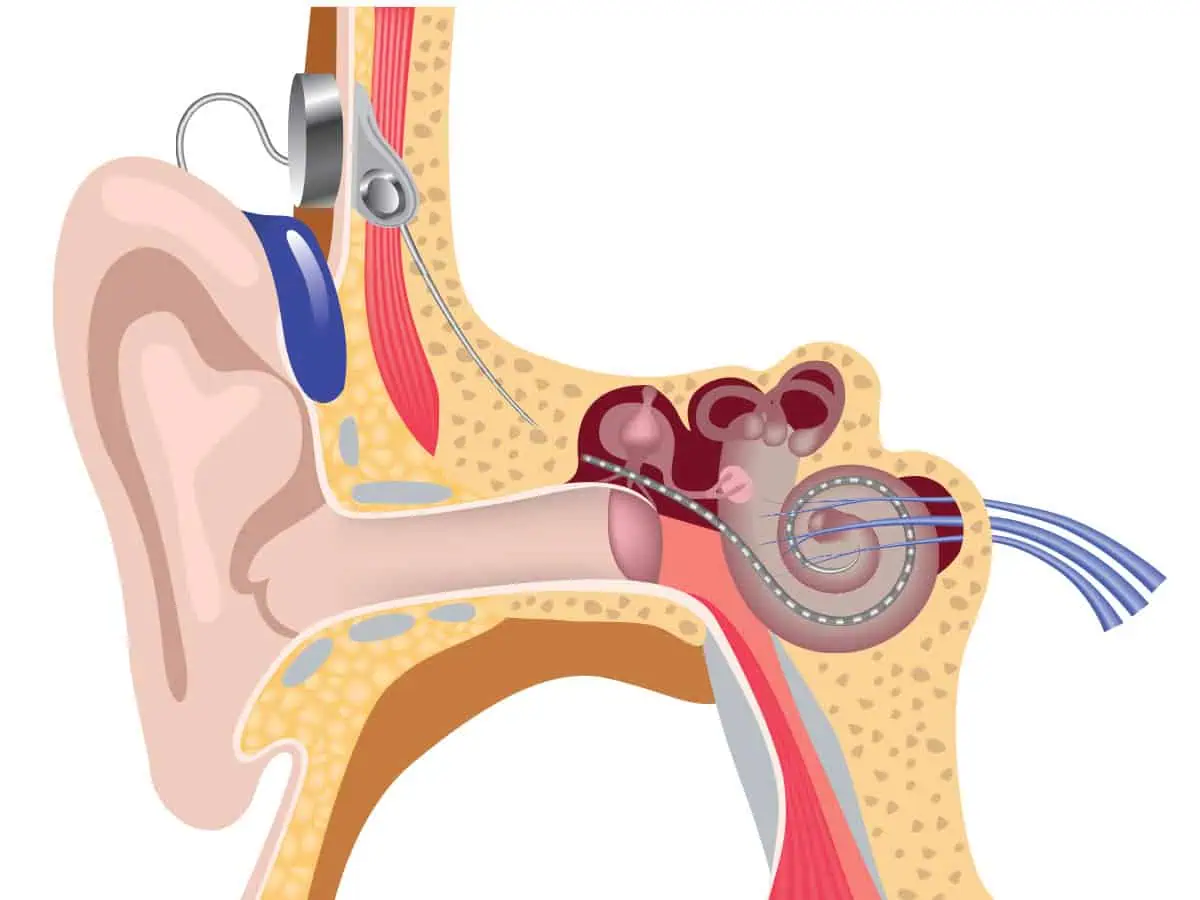Кохлеарна имплантация при пациенти с хроничен отит